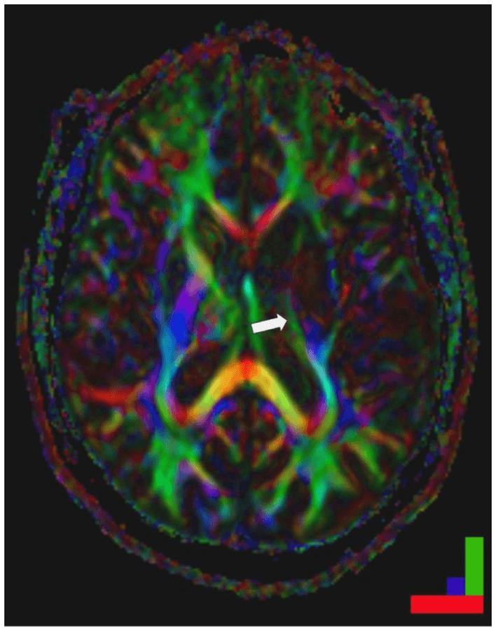 **Imaging Modality:** Diffusion Tensor Imaging (DTI) color map, axial cross-section.
**Anatomical Region:** Cerebrum at the level of the basal ganglia and internal capsule.
**Observed Pathology:** Striatocapsular stroke (Type II.1). There is a focal area of signal loss and structural disruption involving the posterior limb of the left internal capsule (indicated by a white arrow).
**Characteristic Visual Features:**
* **Directional Coding:** The image utilizes standard DTI color-coding: green for anteroposterior (fronto-occipital) diffusion, red for mediolateral (right-left) diffusion, and blue for craniocaudal (dorso-ventral) diffusion.
* **White Matter Integrity:** In the right hemisphere, the internal capsule and corona radiata appear intact with bright, well-defined directional colors. In the left hemisphere, there is a distinct interruption of the blue-coded fibers (descending motor tracts) within the posterior limb of the internal capsule.
* **Lesion Distribution:** The disruption is localized to the deep subcortical white matter, specifically affecting the corticospinal tract pathways.
**Clinical Significance:** The complete destruction of the posterior limb of the internal capsule in this DTI map serves as a neuroanatomical correlate for persistent hemiplegia following a striatocapsular infarct.