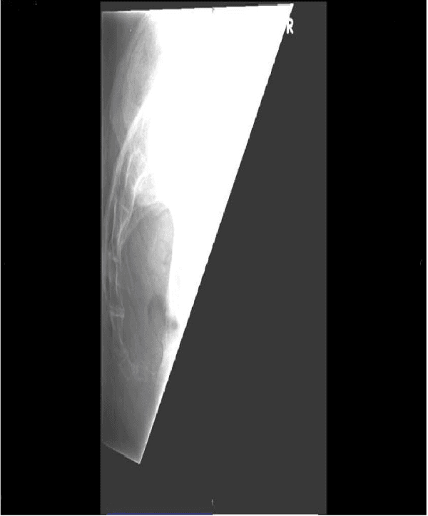 **Imaging Modality:** Conventional Radiography (X-ray).
**Anatomical Region:** Lower pelvic region focusing on the sacrum and coccyx.
**View:** Lateral projection.
**Description of Findings:**
The image displays the terminal portion of the spinal column. The sacrum is visible superiorly, articulating with the coccygeal segments. The coccyx demonstrates an anteverted morphology, characterized by an exaggerated anterior angulation relative to the sacral axis. The coccygeal segments appear intact without definitive evidence of acute cortical disruption or displaced fracture lines visible in this projection. The sacrococcygeal and intercoccygeal joints are visualized, with the distal-most segments curved sharply forward toward the pelvic cavity.
**Characteristic Visual Features:**
* Increased anterior curvature of the coccyx (antiversion).
* Visualization of distinct coccygeal vertebrae and distal sacral segments.
* Lateral orientation providing clear assessment of sagittal alignment.
**Clinical Context/Diagnostic Utility:**
This radiographic finding is indicative of an anatomical variation or positional change of the coccyx. It is a key diagnostic feature used in the evaluation of coccydynia (tailbone pain) to assess for morphological abnormalities, subluxation, or hypermobility that may contribute to clinical symptoms.