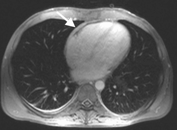 **Imaging Modality:** Cardiac Magnetic Resonance Imaging (MRI), axial plane.
**Anatomical Region:** Mediastinum, specifically focusing on the heart and its surrounding serous membrane.
**Observed Pathology:** The image demonstrates diffuse, significant thickening of the pericardium (indicated by the white arrow). The pericardial layers appear as a prominent, hypointense band surrounding the cardiac chambers.
**Characteristic Visual Features:**
- **Pericardial Thickness:** There is a measurable increase in the pericardial stripe thickness, exceeding the normal physiological limit (typically <2–3 mm).
- **Morphology:** The thickening appears relatively uniform and circumferential along the anterior and lateral aspects of the heart.
- **Signal Intensity:** The thickened tissue exhibits low signal intensity on this pulse sequence, consistent with fibrous or calcified tissue.
**Clinical Significance:** These radiologic findings are highly suggestive of chronic pericarditis or constrictive pericarditis. The image provides a key diagnostic cue by highlighting the structural alteration of the pericardium which may lead to impaired diastolic filling. No significant pleural effusion or pulmonary parenchymal abnormalities are noted in this specific slice.