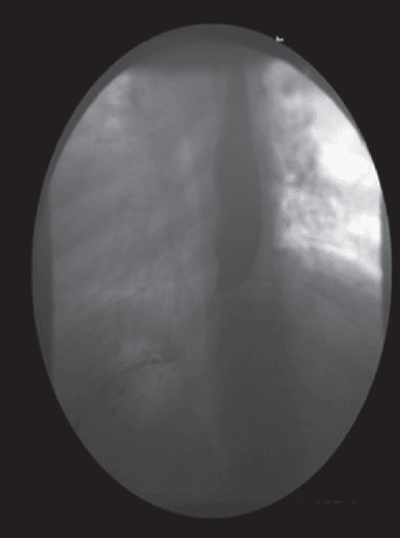 **Imaging Modality:** Barium swallow (esophagram) under fluoroscopy.
**Anatomical Region:** Distal esophagus and gastroesophageal junction (GEJ).
**Observed Pathology:** The image demonstrates findings highly suggestive of achalasia. There is a distinct "bird’s beak" appearance characterized by smooth, symmetric tapering of the distal esophagus.
**Characteristic Visual Features:**
- **Proximal Dilation:** The esophageal body shows significant proximal luminal dilation above the level of obstruction.
- **Distal Tapering:** Sharp, conical narrowing at the gastroesophageal junction.
- **Contrast Flow:** Abrupt cessation of the barium column with only a thin, filiform stream (trickling) of contrast medium passing through the hypertonic lower esophageal sphincter into the gastric cardia.
- **Mucosal Integrity:** The margins of the narrowing appear smooth, without evidence of irregular filling defects or mucosal ulceration, typically distinguishing this from malignant pseudoachalasia.
**Key Diagnostic Features:** Symmetric tapering ("bird’s beak" sign) and delayed esophageal emptying, indicative of impaired lower esophageal sphincter relaxation and aperistalsis.