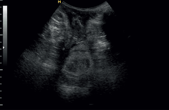 **Imaging Modality:** Two-dimensional (2D) transperitoneal ultrasound.
**Anatomical Region:** Female pelvis, focusing on the uterine cervix in a transverse (axial) cross-section.
**Observed Findings:** The image demonstrates a transverse view of the uterine cervix. Electronic calipers (indicated by ‘+’ markers and a dotted line) are positioned to measure the transverse diameter of the cervical canal, assessing for cervical dilation.
**Characteristic Visual Features:**
- The cervix appears as a circular, hypoechoic structure with a central echogenic or slightly dilated lumen.
- The surrounding pelvic soft tissues are visible with varying echogenicity.
- Measurement markers are placed at the maximum lateral margins of the internal or external cervical os to quantify the degree of opening.
**Clinical Context:** This scan is used in obstetric monitoring to assess cervical progression during labor or to evaluate cervical competence in the second trimester of pregnancy.
**Diagnostic Significance:** Quantitative measurement of cervical dilation via transperitoneal ultrasound serves as a non-invasive alternative to digital vaginal examination for monitoring labor progress or assessing risk for preterm birth.