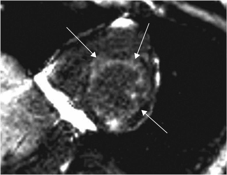 **Modality:** Cardiac Magnetic Resonance Imaging (CMR)
**Sequence:** Late Gadolinium Enhancement (LGE), Short-Axis View
**Anatomy:** Mid-ventricular short-axis cross-section of the left ventricle (LV).
**Observations:**
The image demonstrates a circumferential pattern of hyperintensity within the left ventricular myocardium. This Late Gadolinium Enhancement (LGE) is primarily subendocardial in distribution, appearing as a patchy, bright signal involving the anterior, septal, inferior, and lateral segments. In several areas, the enhancement extends beyond the subendocardium into the mid-myocardium. The right ventricle is partially visualized adjacent to the interventricular septum.
**Pathological Features:**
The non-coronary, circumferential subendocardial enhancement pattern is characteristic of systemic infiltrative or inflammatory processes, such as cardiac amyloidosis or systemic sclerosis, rather than a single-vessel territory myocardial infarction. The presence of these findings indicates replacement fibrosis or expansion of the extracellular space within the myocardial wall.
**Key Search Terms:** Cardiac MRI, Late Gadolinium Enhancement (LGE), subendocardial enhancement, circumferential myocardial fibrosis, short-axis view, infiltrative cardiomyopathy.
