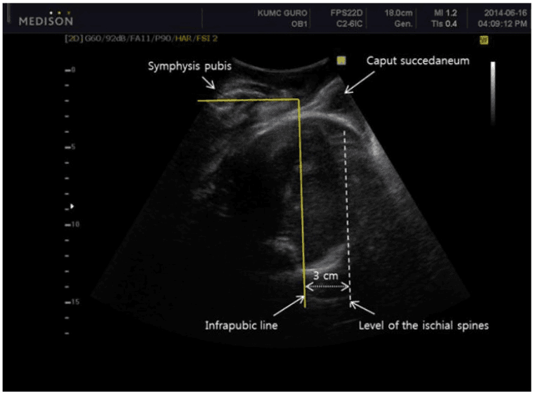 **Imaging Modality:** Two-dimensional (2D) transperineal ultrasound.
**Anatomical Region:** Maternal pelvis and fetal head during labor.
**Observed Anatomy & Landmarks:**
- **Maternal Landmarks:** The symphysis pubis is visible superiorly as a hyperechoic structure. The "infrapubic line" is represented by a solid yellow line drawn perpendicular to the long axis of the symphysis pubis.
- **Fetal Landmarks:** The fetal head is visible within the pelvic canal. A "caput succedaneum" (localized scalp edema) is identified as a hypoechoic soft tissue swelling superficial to the fetal skull.
**Key Measurements & Findings:**
The image demonstrates the spatial relationship used to determine fetal station via ultrasound. A dotted vertical line marks the "level of the ischial spines," situated 3 cm caudal (posterior in this orientation) to the solid "infrapubic line." This 3 cm distance serves as a reference for quantifying the descent of the fetal head relative to the pelvic mid-plane.
**Clinical Significance:** This intrapartum ultrasound assessment provides an objective measurement of fetal head engagement and station, differentiating the true fetal skull position from soft tissue findings like caput succedaneum.