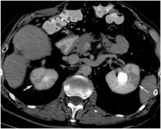 **Modality:** Contrast-enhanced computed tomography (CT) of the abdomen.
**Anatomical Region:** Axial section at the level of the kidneys.
**Observed Pathology:** Bilateral acute pyelonephritis.
**Characteristic Visual Features:**
The image demonstrates bilateral, ill-defined, wedge-shaped areas of decreased parenchymal enhancement (hypoattenuation) within the renal cortex of both kidneys (marked by white arrows). These striated or focal low-attenuation zones represent areas of localized edema and reduced perfusion. The left kidney shows more prominent enlargement compared to the right. There is evidence of mild perinephric stranding. An incidental hyperdense structure is noted in the left renal pelvis, consistent with a renal calculus or concentrated contrast in the collecting system.
**Clinical Context/Differentiating Features:**
The striated nephrogram pattern is a characteristic radiologic sign of acute pyelonephritis. These findings help differentiate inflammatory processes from renal infarction or mass lesions by their distribution across the renal parenchyma and lack of clear borders typical of solid tumors. The presentation is consistent with systemic or ascending urinary tract infection in an immunocompromised or elderly clinical setting.