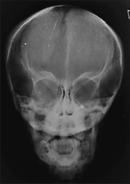 **Imaging Modality:** Posteroanterior (PA) conventional radiograph of the skull.
**Anatomical Region:** Craniofacial skeleton, including the calvarium, orbits, nasal cavity, maxilla, and mandible.
**Observed Pathology and Visual Features:**
* **Cranial Vault:** The skull demonstrates a brachycephalic configuration with a noticeably widened transverse diameter. There is evidence of a persistent, open anterior fontanel and widened cranial sutures. The calvarium appears diffusely thickened with increased bone density.
* **Facial Skeleton:** Marked generalized osteosclerosis is present throughout the facial bones. There is significant hypoplasia of the maxilla and mandible, contributing to a diminished midface and lower face height.
* **Sinuses:** There is a lack of visible pneumatization of the paranasal sinuses, consistent with sinus aplasia or high-grade hypoplasia.
* **Dental/Mandibular:** The mandible appears small and dense, with crowded or unerupted permanent dentition visible.
**Diagnostic Context:** These radiographic findings—specifically the combination of delayed suture closure, osteosclerosis, and midface hypoplasia—are highly characteristic of pyknodysostosis.
**Key Features for Retrieval:** Brachycephaly, open fontanelle, osteosclerosis, maxillary hypoplasia, nonpneumatized sinuses, pyknodysostosis, skeletal dysplasia.