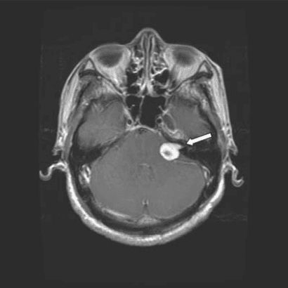 **Imaging Modality:** Gadolinium-enhanced axial T1-weighted Magnetic Resonance Imaging (MRI) of the head.
**Anatomical Region:** Posterior fossa, specifically the left cerebellopontine angle (CPA) and internal auditory canal (IAC).
**Observed Pathology:** A well-circumscribed, intensely enhancing soft tissue mass is situated in the left cerebellopontine angle. The lesion demonstrates a characteristic "ice cream cone" appearance, with a larger globular cisternal component and a narrower intracanalicular portion extending into the left internal auditory canal.
**Characteristic Visual Features:**
* **Enhancement:** Homogeneous and robust uptake of contrast agent.
* **Morphology:** Ovoid mass with smooth margins.
* **Mass Effect:** Minimal displacement of the adjacent pons and cerebellum without significant effacement of the fourth ventricle.
* **Location:** Centered at the porus acusticus.
**Diagnostic Features:** The location and morphology are highly characteristic of a vestibular schwannoma (acoustic neuroma). Key differentiating features include the widening of the internal auditory canal and the acute angles formed between the lesion and the petrous temporal bone, distinguishing it from a CPA meningioma.
