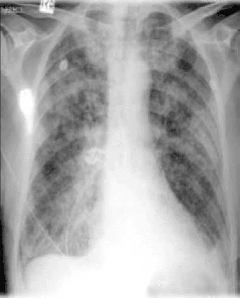 **Imaging Modality:** Anteroposterior (AP) Chest Radiograph (X-ray).
**Anatomical Region:** Thoracic cavity, including the lungs, mediastinum, and cardiophrenic angles.
**Observed Pathology:** The image demonstrates diffuse, bilateral interstitial and alveolar opacities consistent with severe pulmonary congestion and edema. There is evidence of cephalization of the pulmonary vessels (upper lobe venous diversion).
**Characteristic Visual Features:**
* **Parenchymal Findings:** Extensive "bat-wing" or perihilar distribution of opacities. Presence of Kerley B lines is suggested by peripheral linear densities at the lung bases.
* **Cardiac/Mediastinal Findings:** Marked cardiomegaly with an increased cardiothoracic ratio. The cardiac silhouette is widened, indicating ventricular enlargement.
* **Pleural Findings:** Blunting of the costophrenic angles, particularly on the left, indicative of bilateral pleural effusions.
**Differentiating Features:** The combination of cardiomegaly, cephalization, perihilar opacification, and pleural effusions strongly characterizes congestive heart failure (CHF) leading to pulmonary edema, distinguishing it from primary pneumonia or focal lung masses.
**Clinical Context:** Radiologic features are diagnostic of acute decompensated heart failure with associated pulmonary venous hypertension.