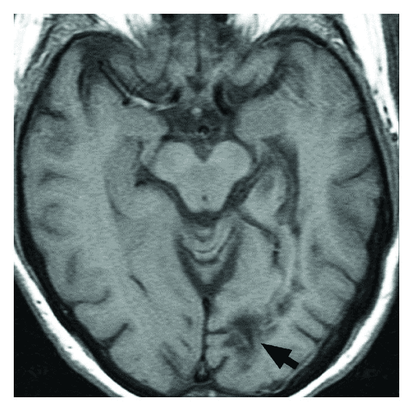 **Modality:** Magnetic Resonance Imaging (MRI)
**Sequence:** Axial T1-weighted image
**Anatomical Region:** Brain; specifically the posterior supratentorial compartment at the level of the midbrain and occipital lobes.
**Observed Pathology:**
There is a focal area of T1-hypointensity located in the left parieto-occipital region, consistent with a localized cortical and subcortical cerebral infarction. The lesion is demarcated by a black arrow, highlighting its involvement within the visual processing pathways or associated association fibers.
**Visual Features:**
- **Signal Intensity:** Low signal intensity (hypointense) on T1-weighted imaging, suggesting tissue necrosis or edema characteristic of an established or subacute infarct.
- **Distribution:** Unilateral, localized to the left posterior cortex near the midline and parieto-occipital junction.
- **Landmarks:** The midbrain (mesencephalon) is visible centrally with normal morphology; the lateral ventricles are partially visualized anterior to the lesion.
**Diagnostic Significance:**
The location of the infarct in the left parieto-occipital lobe is clinically significant for potential visual field deficits (e.g., right homonymous hemianopsia) or visuospatial neglect, which are critical factors in assessing functional safety and neurological impairment.