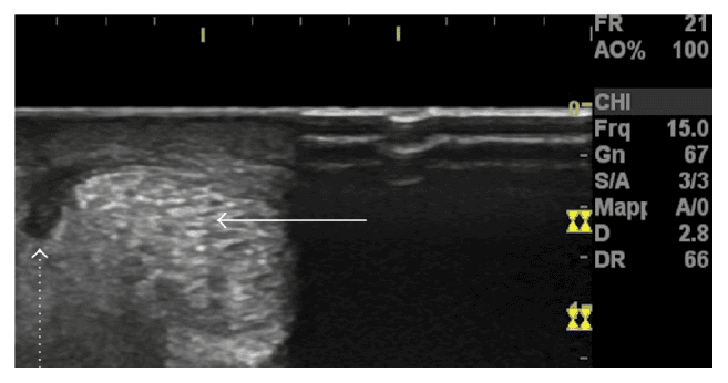**Imaging Modality:** High-resolution musculoskeletal ultrasound (MSKUS).
**Anatomical Region:** Achilles tendon, axial (transverse) cross-sectional view.
**Observed Pathology:** Acute paratendinopathy with associated peritendinous fluid collection.
**Visual Features:**
* **Achilles Tendon:** The main body of the tendon (indicated by a solid white arrow) displays a characteristic speckled, hyperechoic fibrillar pattern in the transverse plane.
* **Fluid Collection:** A distinct, well-defined hypoechoic (dark) crescentic area is visible at the lateral periphery of the tendon (indicated by a dotted arrow).
* **Localization:** The hypoechoic region is situated between the tendon substance and the overlying paratenon, consistent with inflammatory exudate or fluid accumulation.
* **Surrounding Tissue:** The superficial soft tissues and skin layers are visible superior to the tendon structure.
**Clinical Significance:** This sonographic presentation is characteristic of acute paratendinopathy, where the primary inflammatory process involves the tendon sheath (paratenon) rather than the tendon transition itself. The presence of peritendinous fluid is a key diagnostic marker for differentiating acute paratenon inflammation from chronic tendinosis or mid-portion tears.