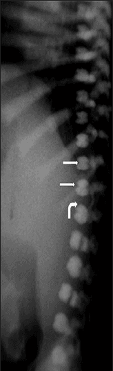 **Imaging Modality:** Lateral projection radiograph (X-ray).
**Anatomical Region:** Thoracolumbar spine and posterior rib cage.
**Observed Pathology:** Generalized osteosclerosis consistent with osteopetrosis (Albers-Schönberg disease).
**Characteristic Visual Features:**
* **Sandwich Vertebra Sign:** The vertebral bodies exhibit dense, sclerotic bands at the superior and inferior endplates (curved arrow) with relative central radiolucency (straight arrows), creating a distinct layered or "sandwich" appearance.
* **Diffuse Sclerosis:** Increased radiodensity is visible across the visualized vertebrae and posterior ribs, indicating a systemic failure of osteoclast-mediated bone resorption.
* **Bone-within-bone Appearance:** The morphology of the vertebral bodies suggests an endosteal thickening pattern typical of metabolic bone disorders.
**Key Diagnostic Features:** The "sandwich vertebra" sign is a pathognomonic radiologic finding for osteopetrosis, distinguishing it from other causes of vertebral sclerosis such as Paget’s disease (which typically presents with a "picture frame" vertebra) or renal osteodystrophy (rugger-jersey spine). This presentation in an infant is highly indicative of the autosomal recessive (malignant) form of the condition.