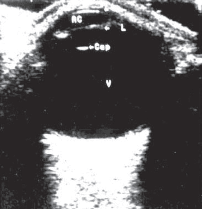 **Imaging Modality:** Ophthalmic B-scan ultrasonography.
**Anatomical Region:** Globe (eyeball), axial cross-section.
**Observations:**
The image demonstrates the normal anatomical structures of the eye. The anterior segment displays the anterior chamber (labeled AC) and the crystalline lens (L). A distinct, curvilinear hyperechoic signal represents the posterior lens capsule (labeled ‘cap’). The posterior segment is dominated by a large, homogeneous, anechoic (black) space representing a clear vitreous chamber (V), devoid of opacities, membranes, or hemorrhages. The posterior wall shows a smooth, continuous hyperechoic curvilinear interface corresponding to the retina-choroid-sclera complex.
**Characteristic Visual Features:**
- **Anechoic Vitreous:** Indicates the absence of vitreous syneresis, debris, or posterior vitreous detachment (PVD).
- **Lens Landmarks:** Clear visualization of the lens boundaries and the acoustic interface of the posterior capsule.
- **Intact Posterior Contour:** Maintains a normal spherical configuration without evidence of staphyloma, retinal detachment, or choroidal thickening.
**Clinical Significance:** This image serves as a baseline reference for normal ocular ultrasonography, used to rule out intraocular pathology such as vitreous hemorrhage, retinal detachment, or intraocular tumors.
