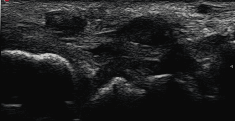 **Imaging Modality:** Musculoskeletal Ultrasound (grey-scale)
**Anatomical Region:** Ulnar aspect of the wrist, transverse view.
**Observed Pathology:** Tenosynovitis of the extensor carpi ulnaris (ECU).
**Characteristic Visual Features:** The image demonstrates significant hypoechoic thickening of the synovial sheath surrounding the ECU tendon. The tendon itself is visualized within the sixth extensor compartment. There is evidence of synovial hypertrophy and anechoic to hypoechoic fluid accumulation (effusion) within the tendon sheath, indicative of an inflammatory process. The underlying bony cortex of the distal ulna is visible as a hyperechoic curvilinear interface with posterior acoustic shadowing.
**Diagnostic Differentiating Features:** The circumferential distribution of hypoechoic material around the tendon within the fibro-osseous tunnel is characteristic of exudative and proliferative tenosynovitis. This presentation is distinct from simple tendinosis due to the primary involvement of the surrounding sheath rather than the internal fibrillar structure of the tendon itself.